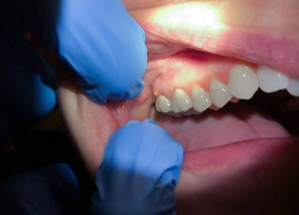 Best Broken or Cracked Tooth Emergency Dentist in Cordova, AL